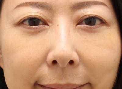 脱脂＋脂肪注入のダウンタイム術後1週間