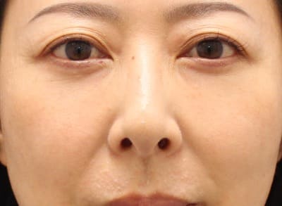 脱脂＋脂肪注入のダウンタイム術後2週間