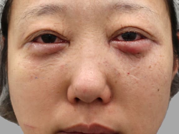 裏ハムラのダウンタイム手術直後