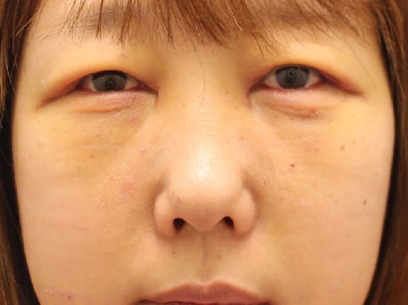 裏ハムラのダウンタイム術後3日-２