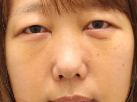裏ハムラのダウンタイム術後1週間