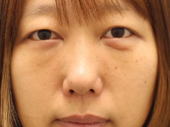 裏ハムラのダウンタイム術後2週間