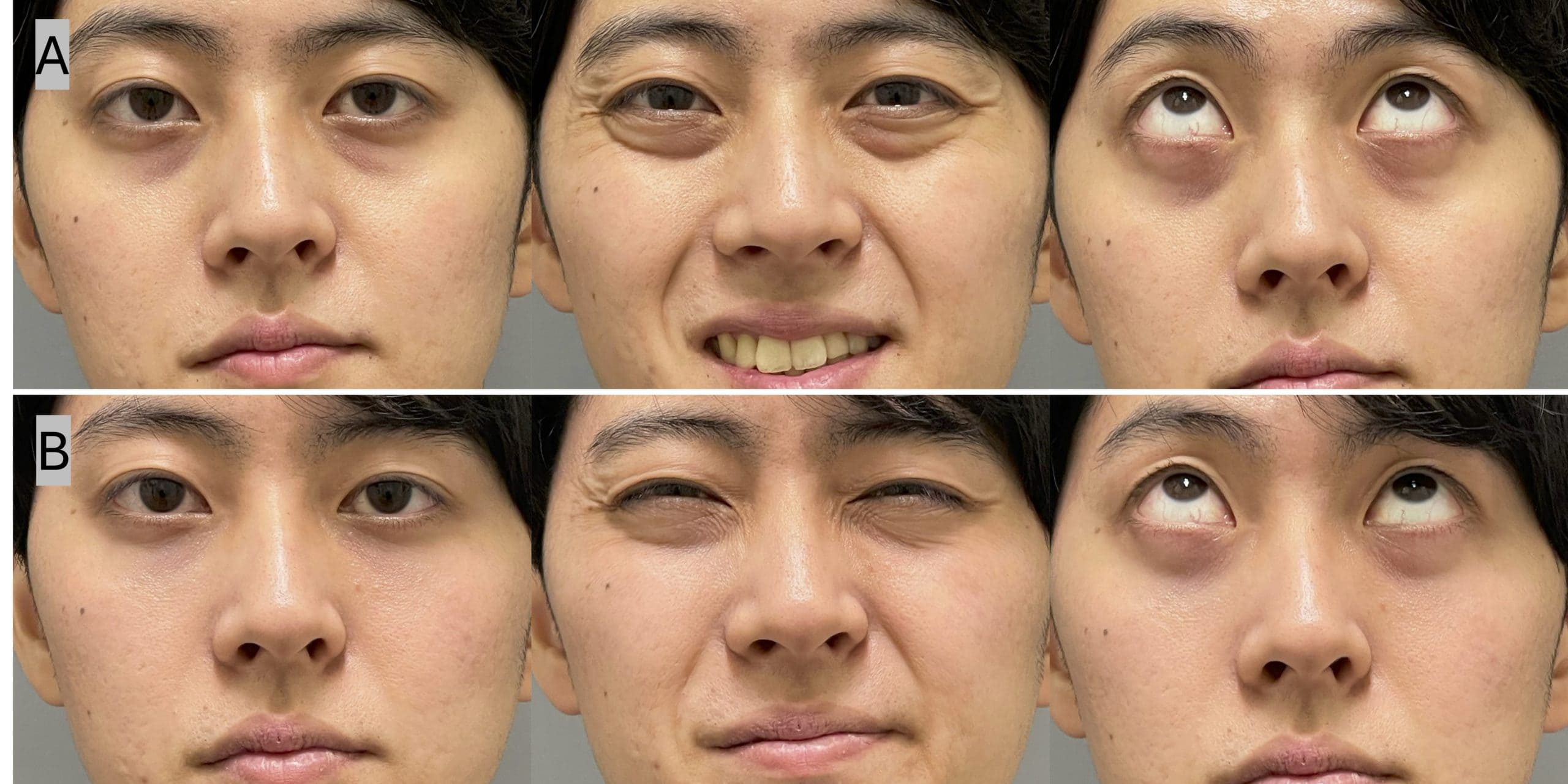 30代男性・裏ハムラ適応だが脂肪不足（脱脂＋脂肪注入）