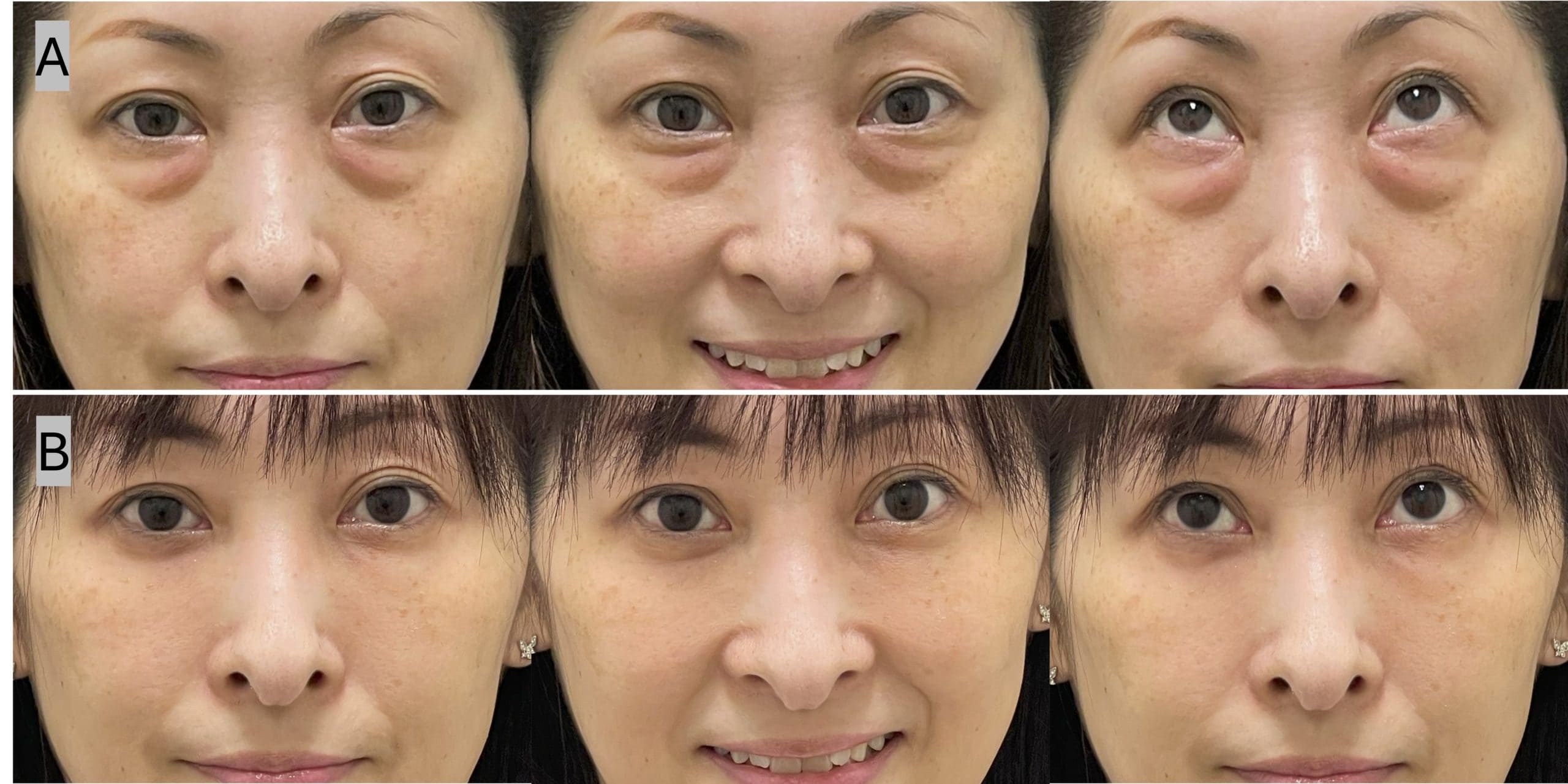 40代・巨大な目袋＋皮膚の薄さ（裏ハムラ法）