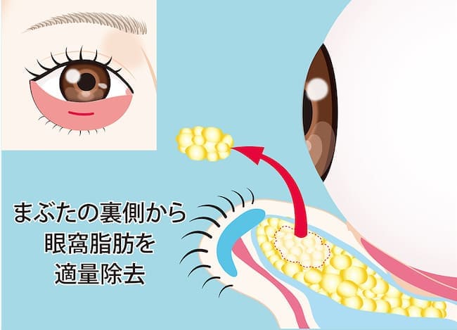 経結膜脱脂法のイメージ