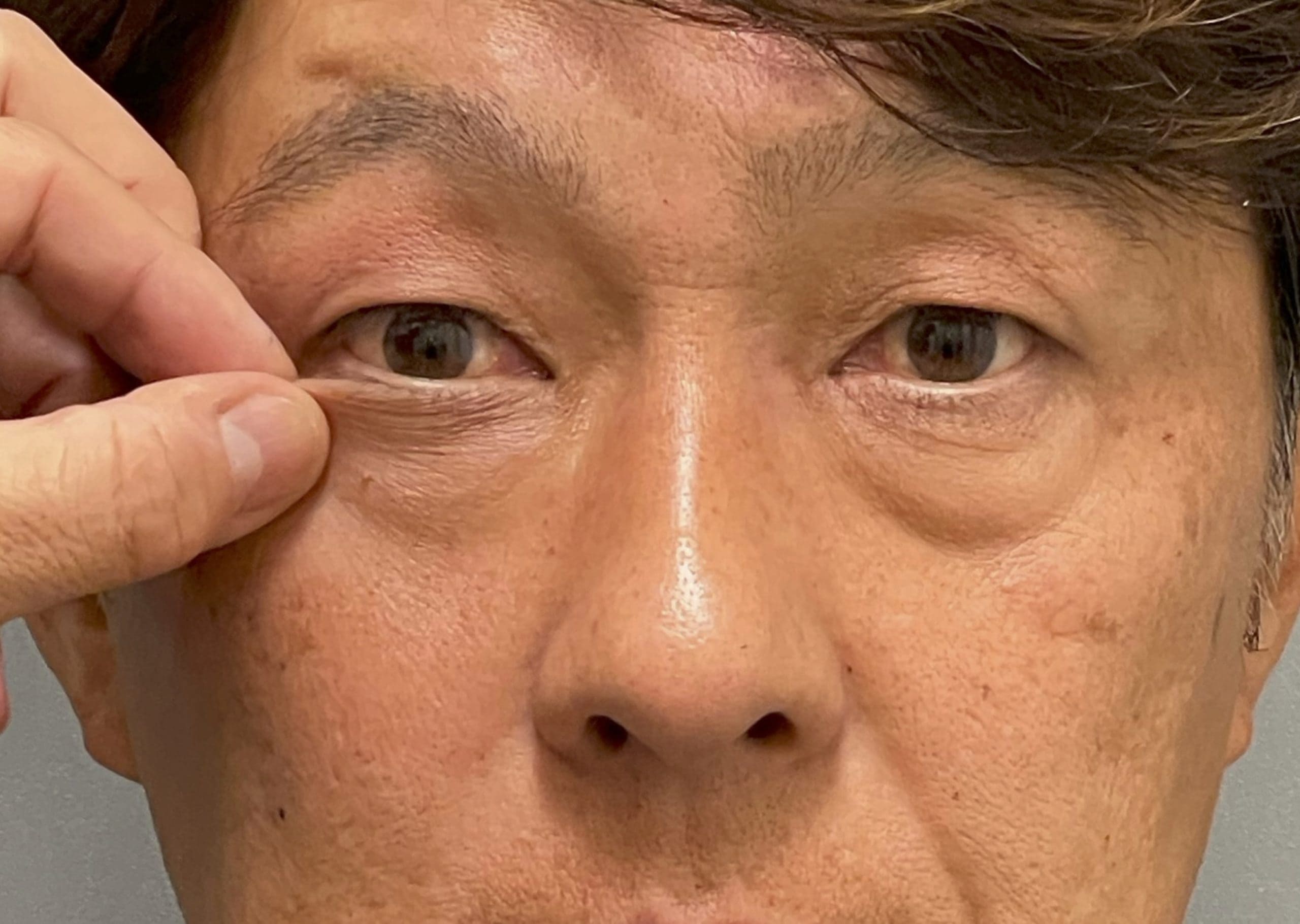 皮膚をつまんで引き上げる