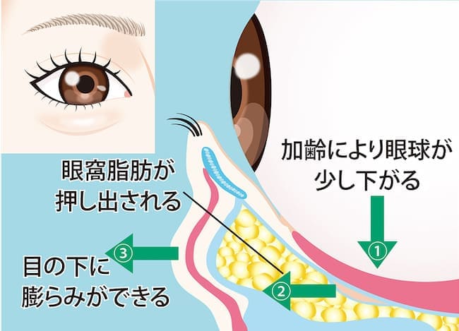 黒グマ（影グマ）