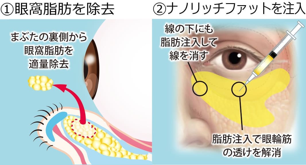 脱脂＋脂肪注入法