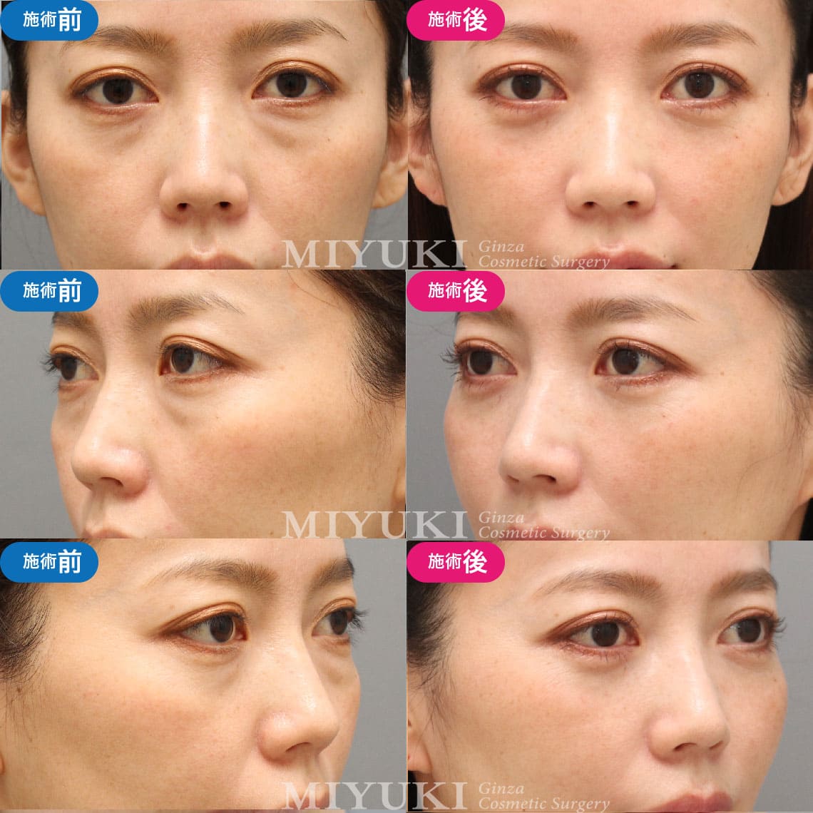脱脂＋脂肪注入法：40代女性の症例