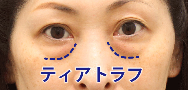 ティアトラフ（目の下の溝）