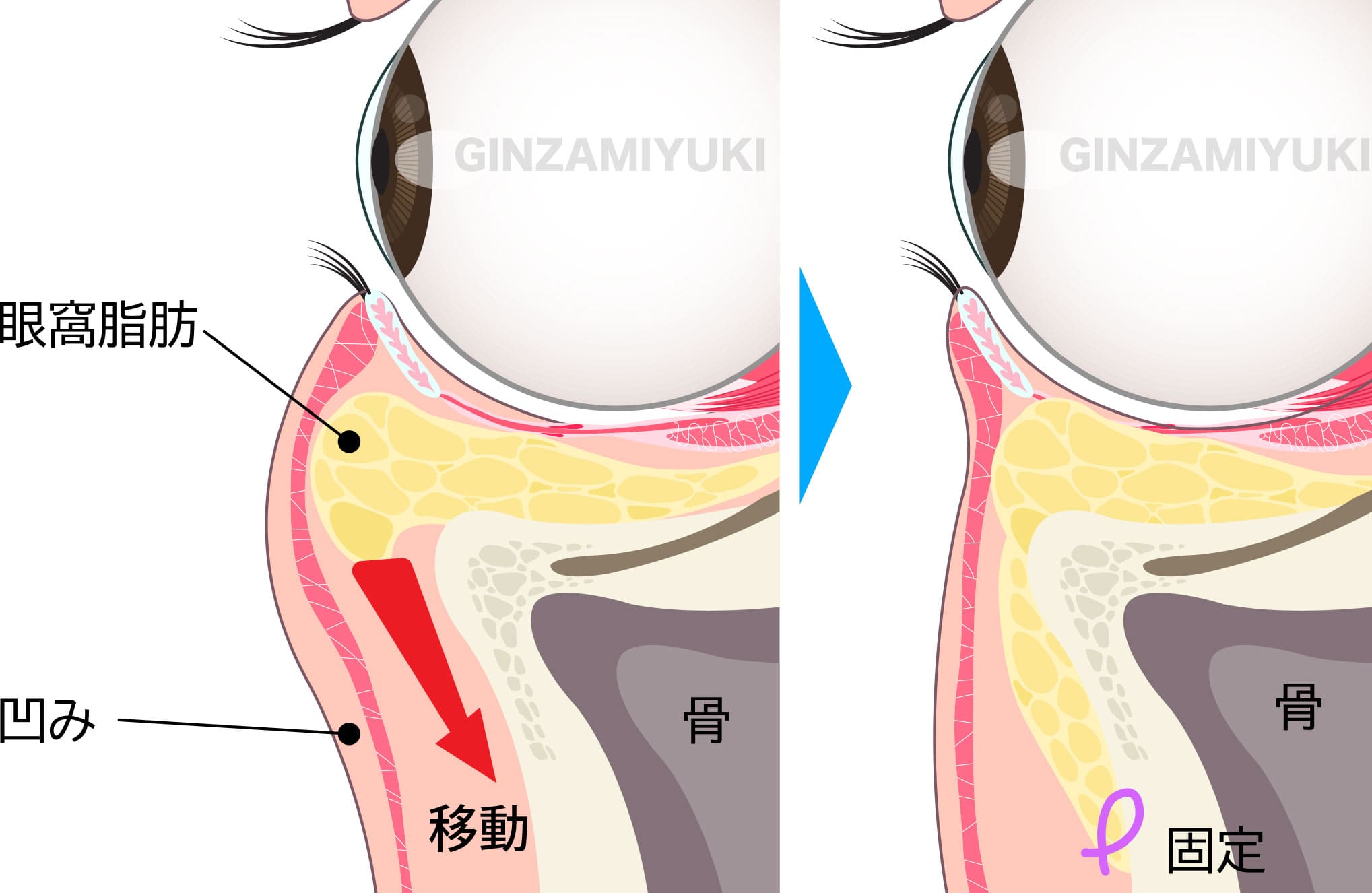 裏ハムラ法（経結膜的眼窩脂肪移動術）