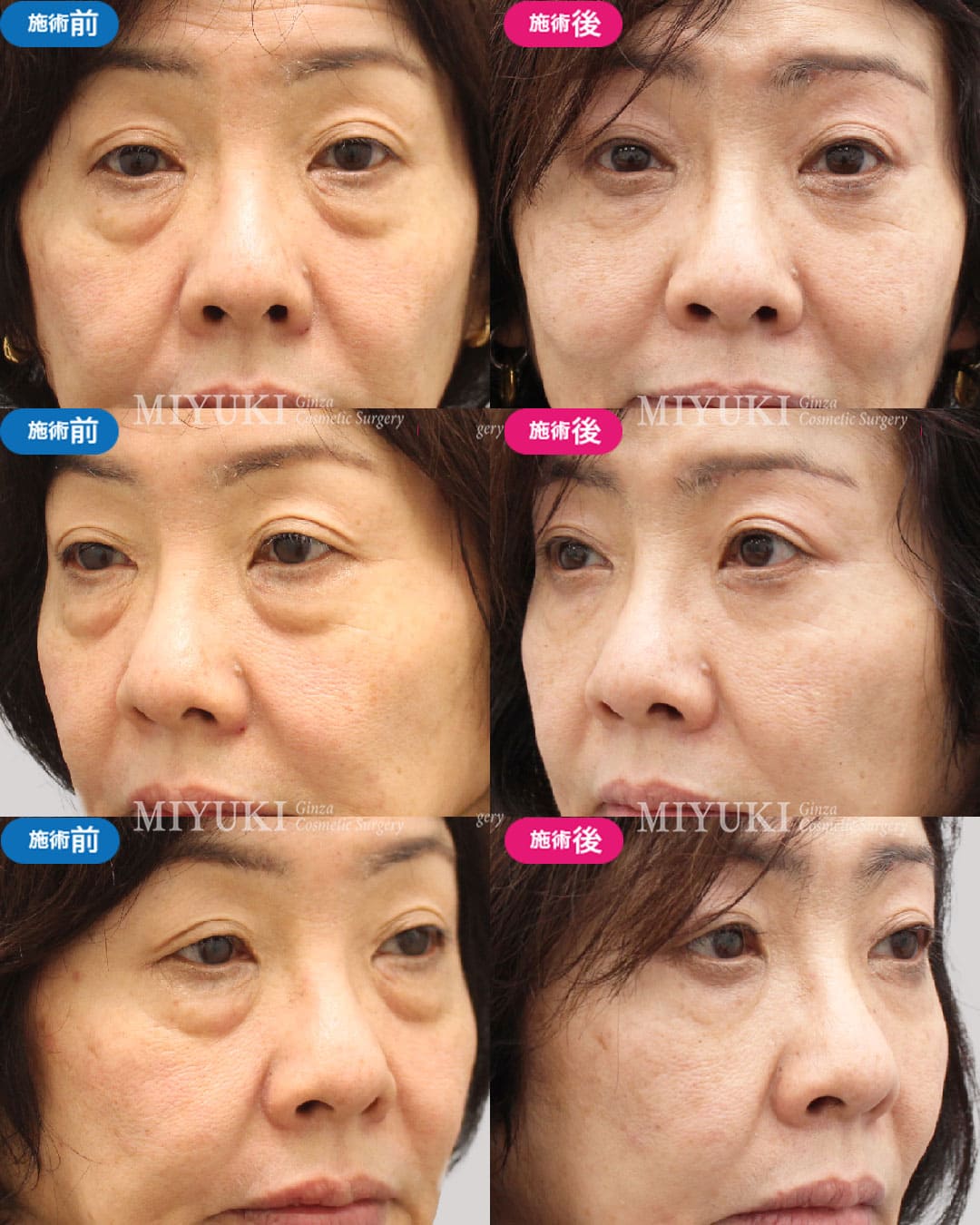表ハムラ法の症例：50代女性