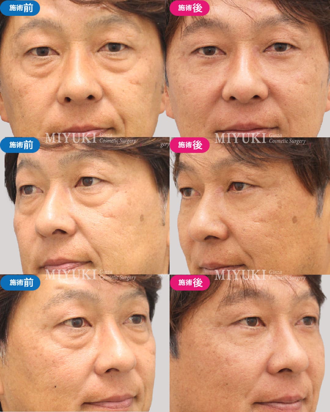 表ハムラ法の症例：50代男性