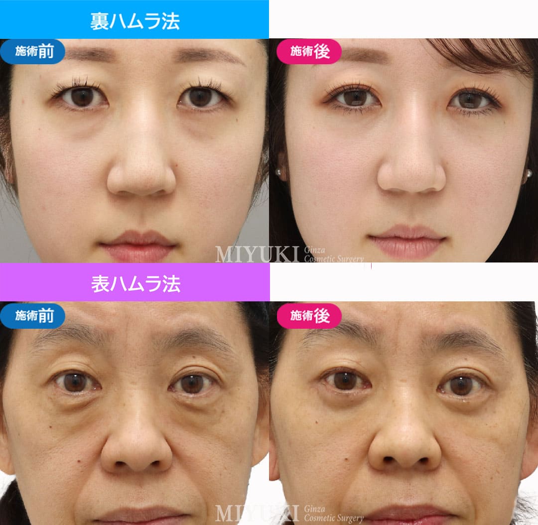 目の下のクマ「表ハムラ法・裏ハムラ法の術前術後01」