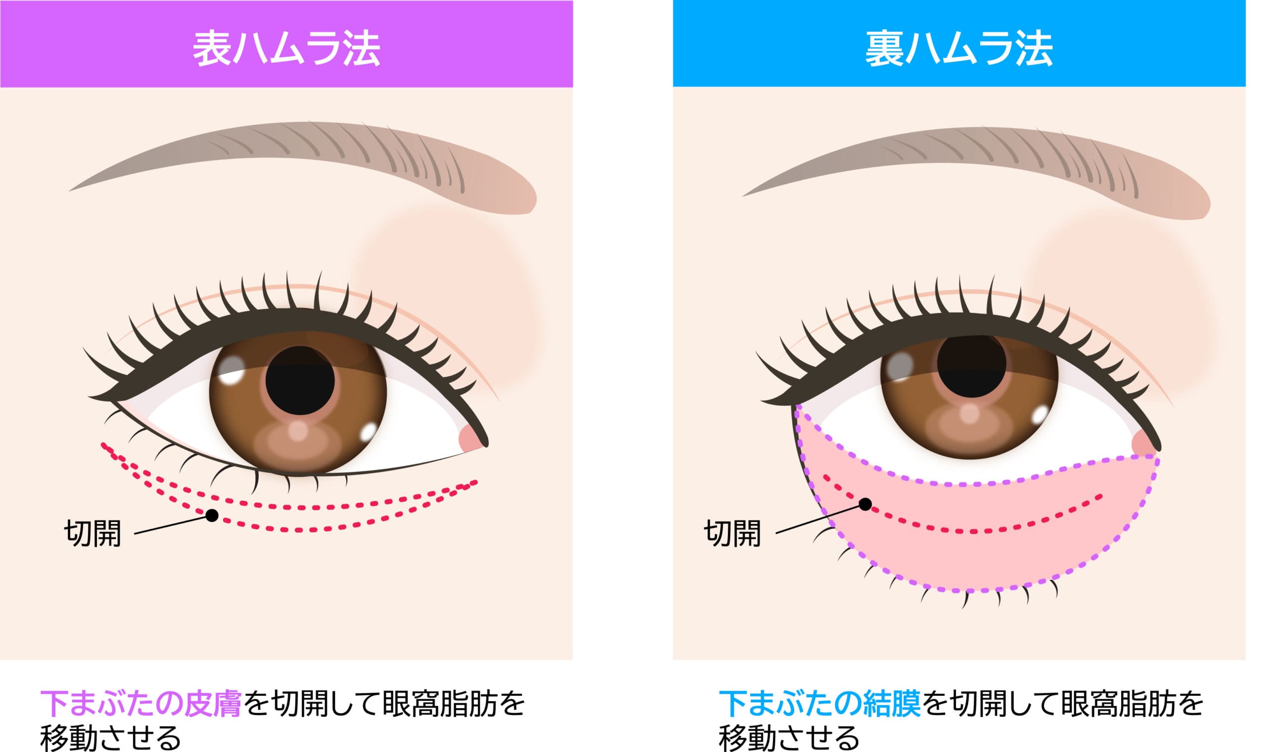 目の下のクマ「表ハムラ法・裏ハムラ法の術式01」