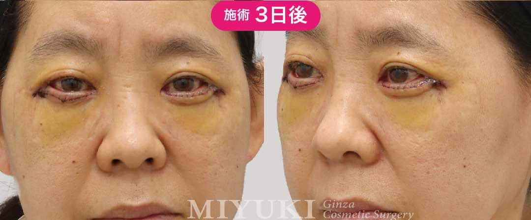 目の下のクマ「表ハムラ術後３日後」