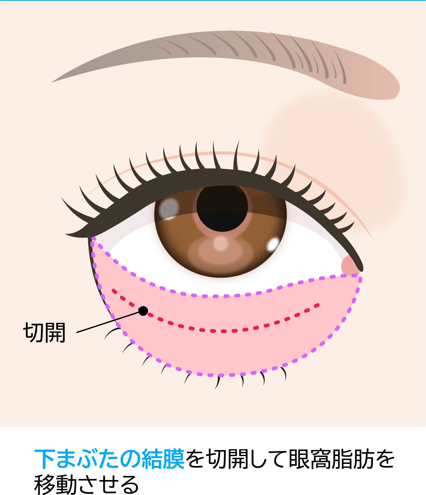 眼球を保護し下まぶたの裏側（結膜側）を切開