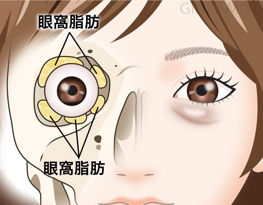 眼窩脂肪のイメージ