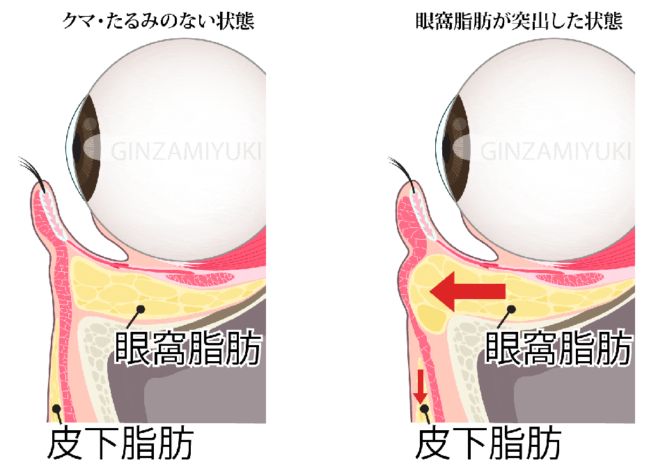 正常な眼窩脂肪の状態と眼窩脂肪が突出してクマの症状になっているケースのイメージ