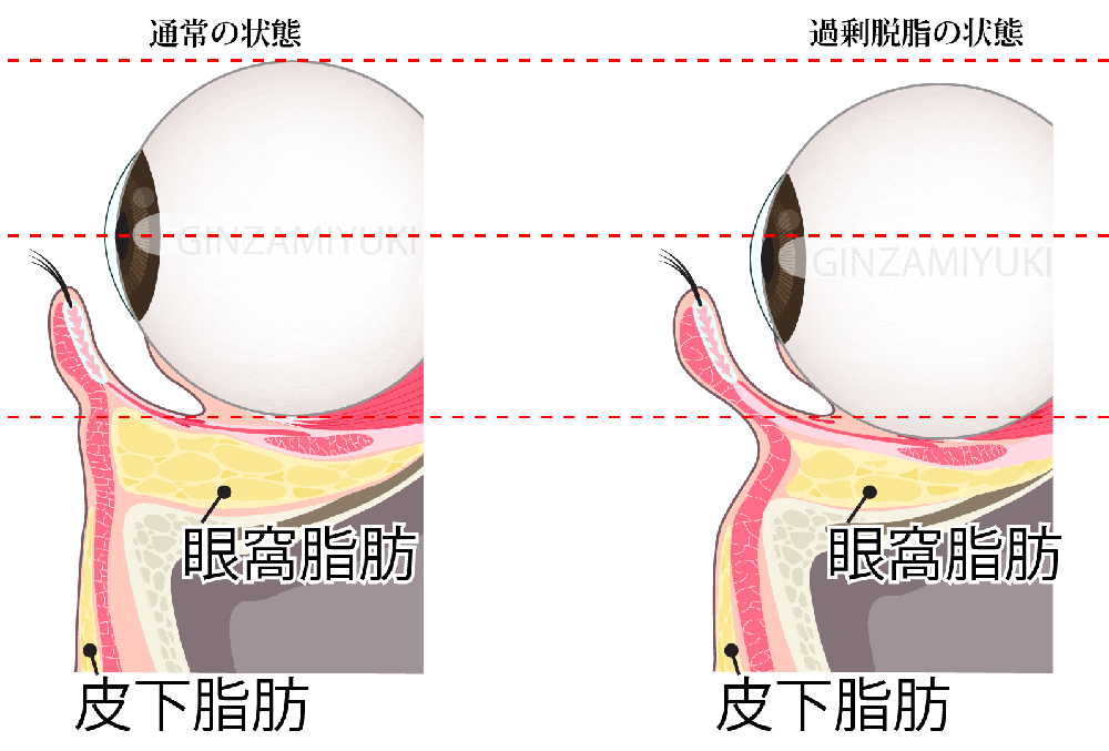 過剰な眼窩脂肪除去により眼球が下がったケースのイメージ