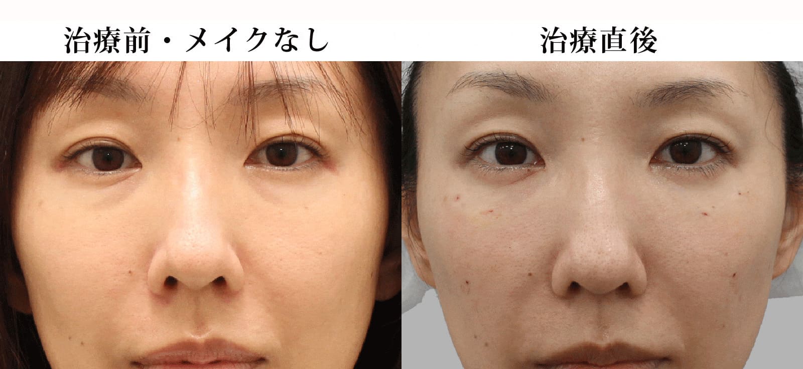 施術前と施術直後の状態比較