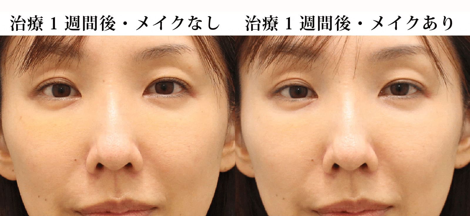 1週間後のダウンタイム状況