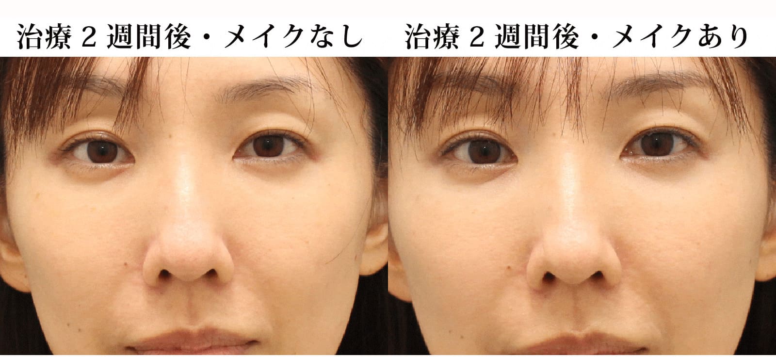 2週間後のダウンタイム状況