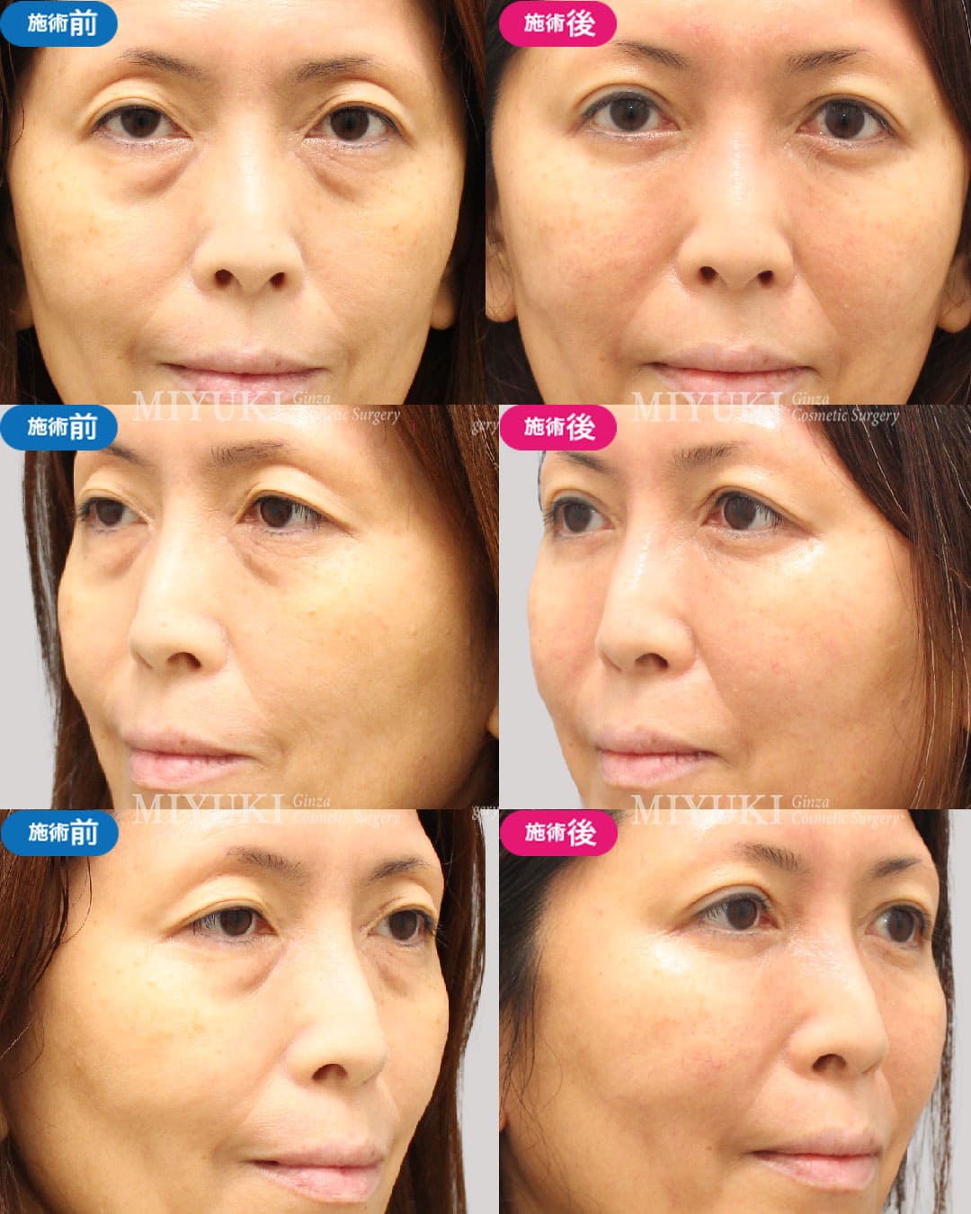 目の下のくま施術症例1