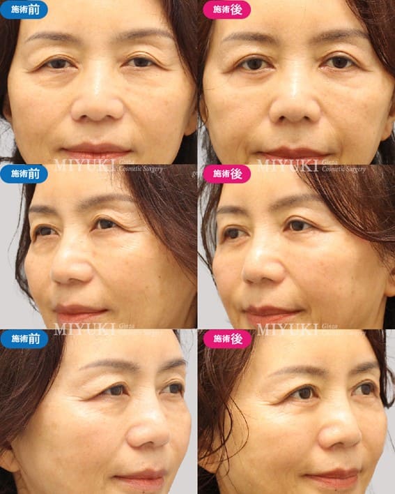 目の下のくま施術症例3
