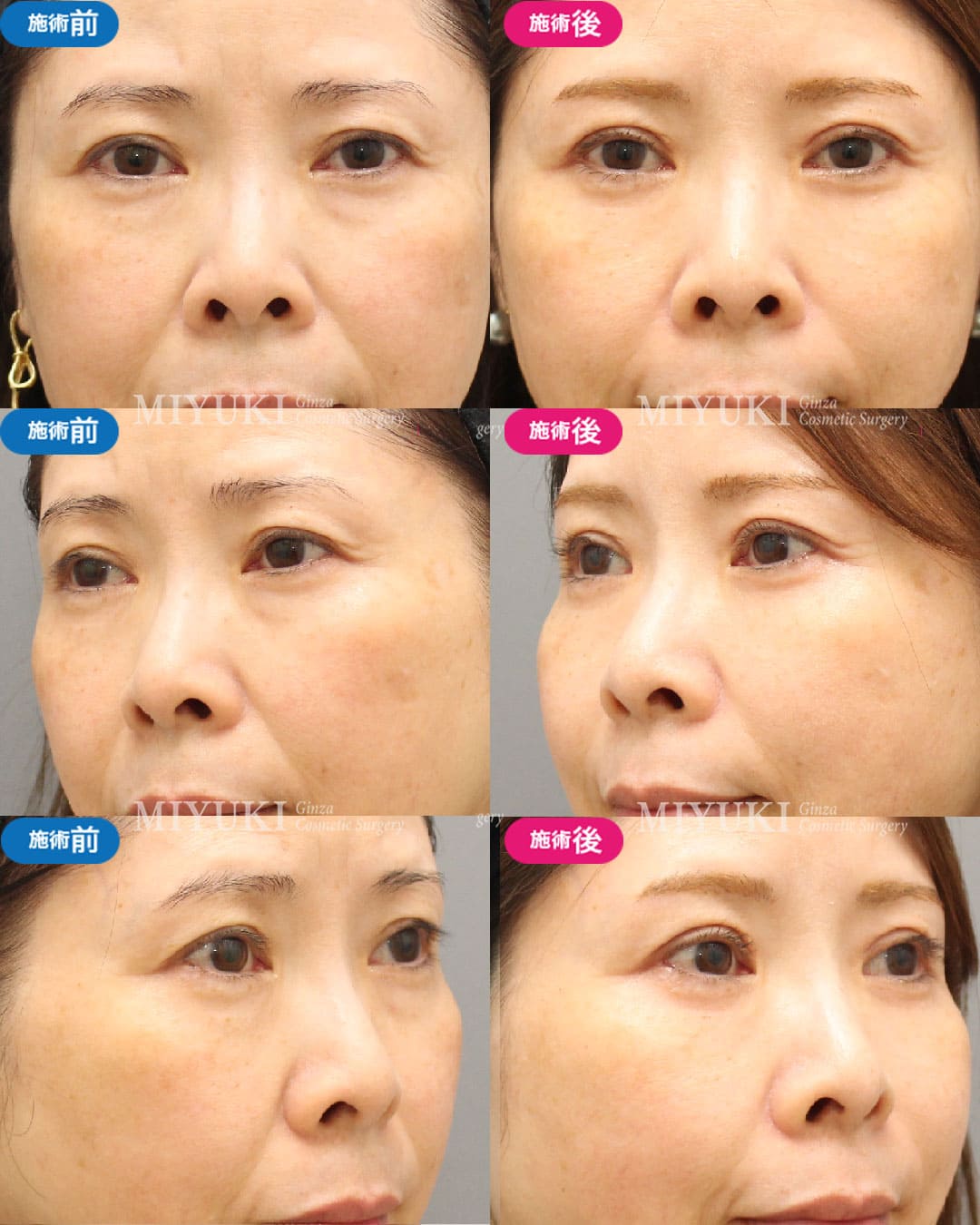 目の下のくま施術症例4