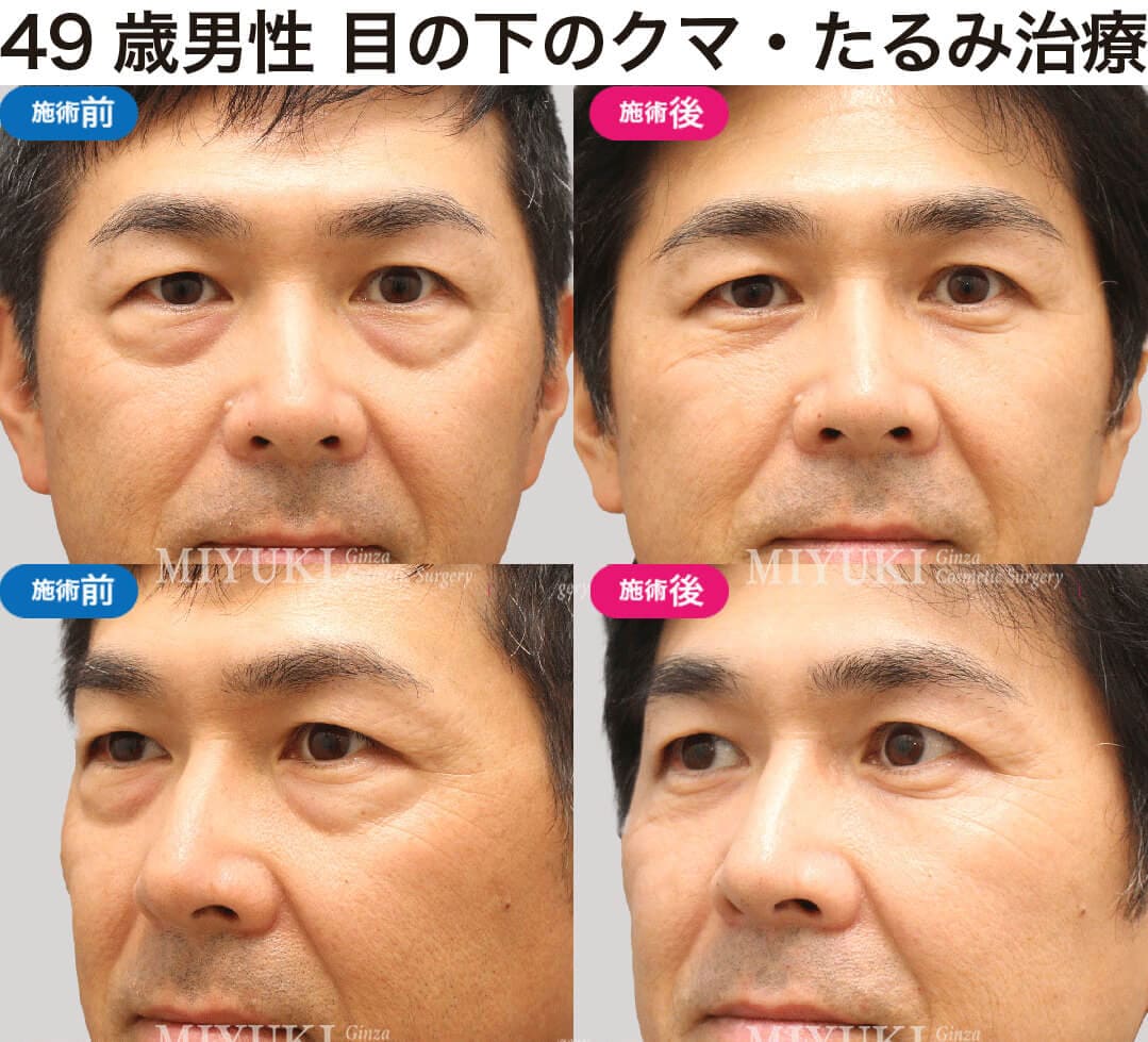男性の目の下のくま治療の症例１