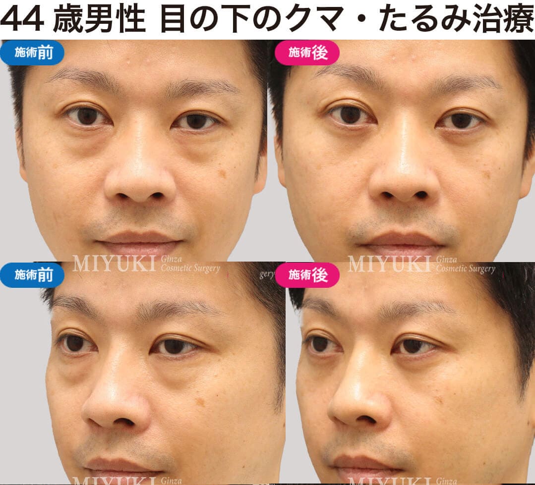 男性の目の下のくま治療の症例２