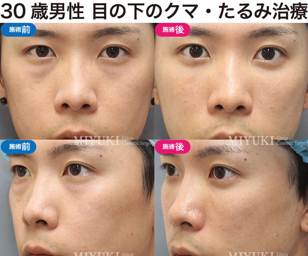 男性の目の下のくま治療の症例３