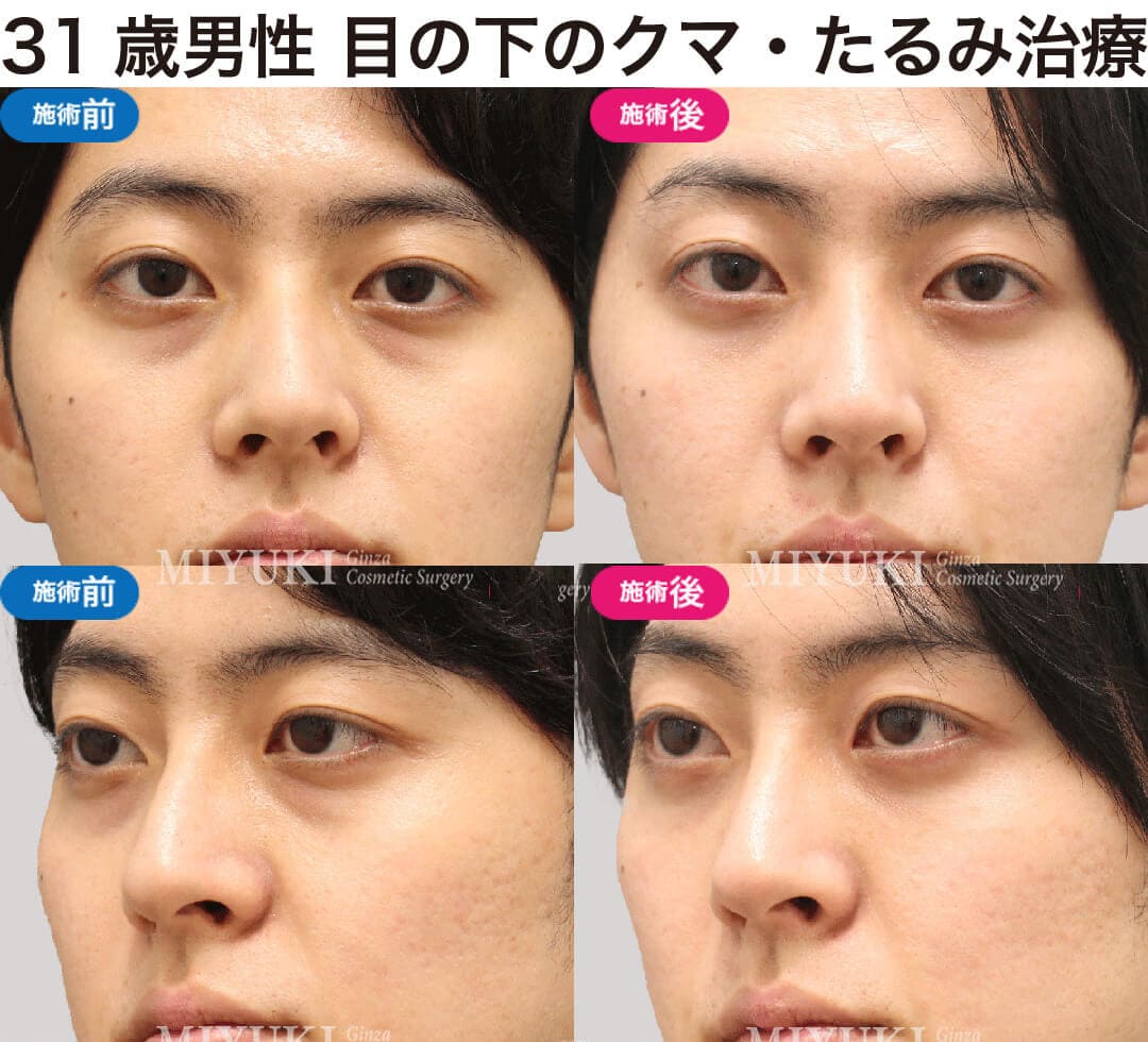 男性の目の下のくま治療の症例４