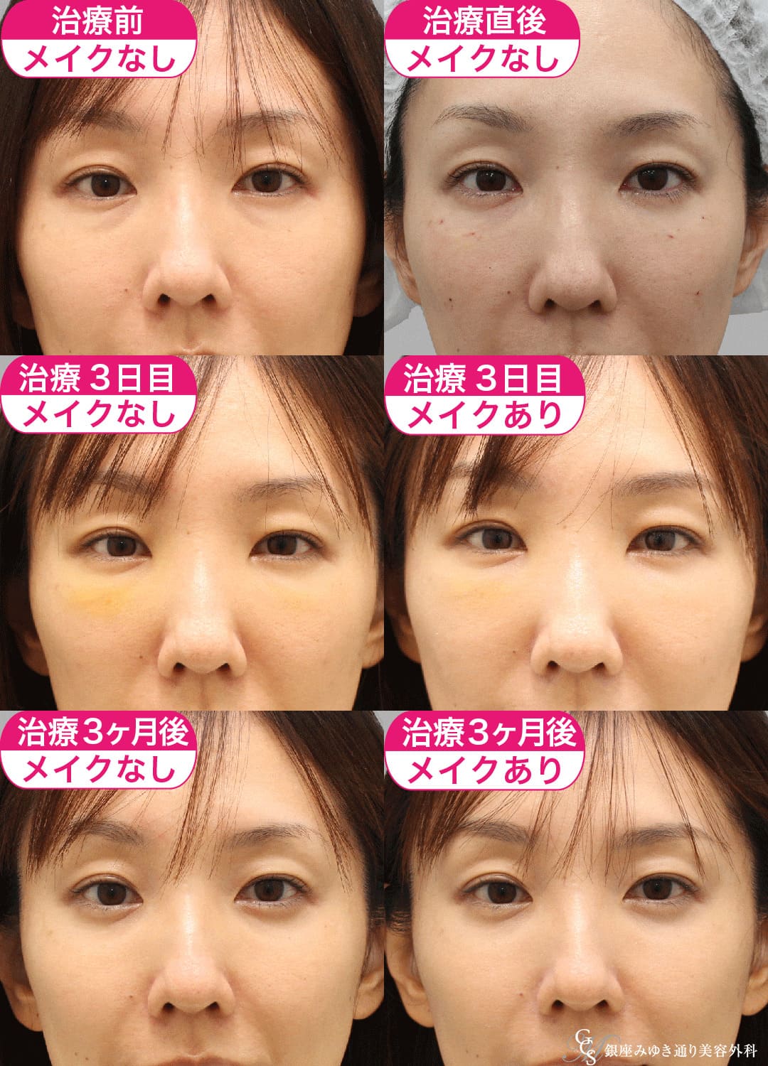 目の下のクマ治療の症例１