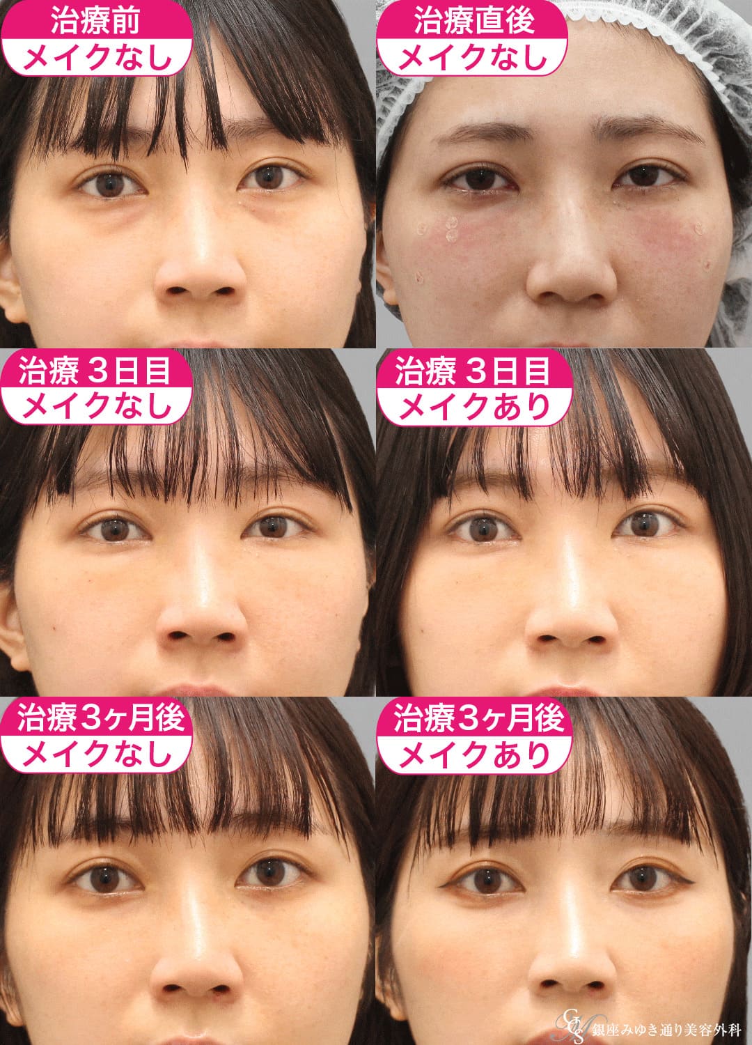 目の下のクマ治療の症例２