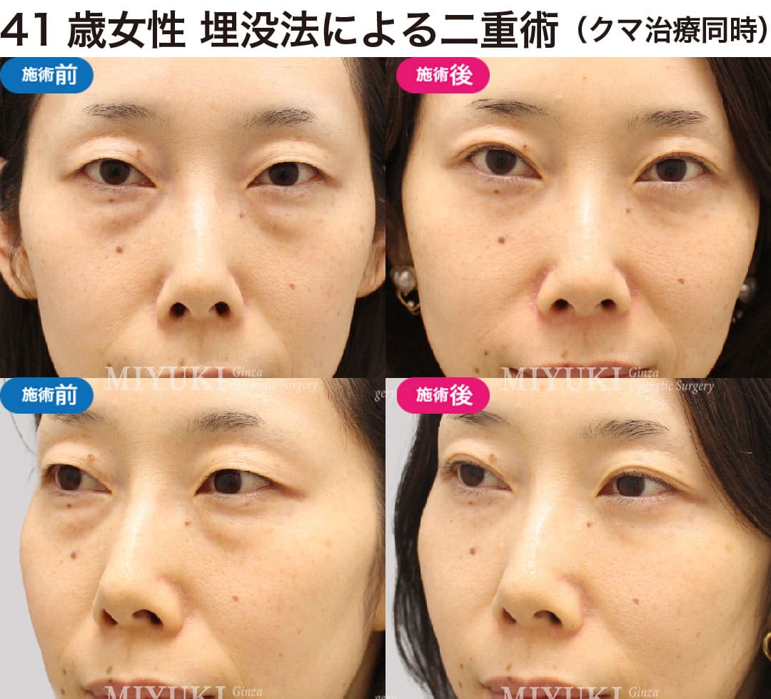 40代から始める大人の二重まぶた治療の症例１
