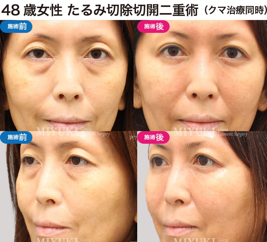 40代から始める大人の二重まぶた治療の症例２