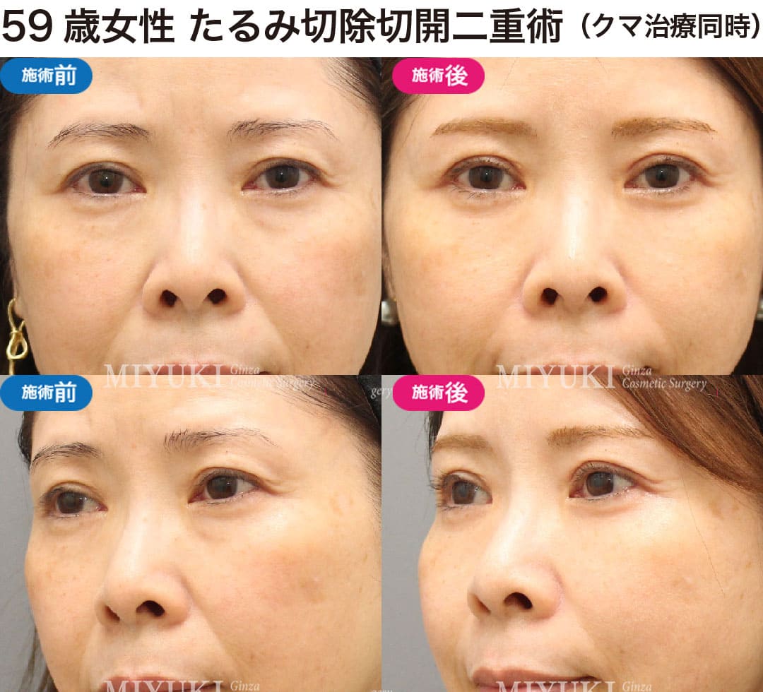 40代から始める大人の二重まぶた治療の症例３