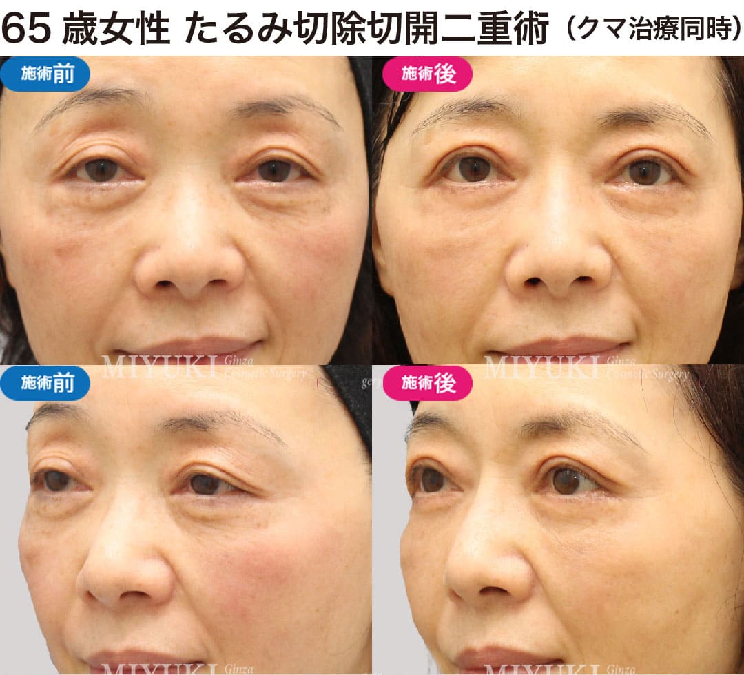 40代から始める大人の二重まぶた治療の症例４