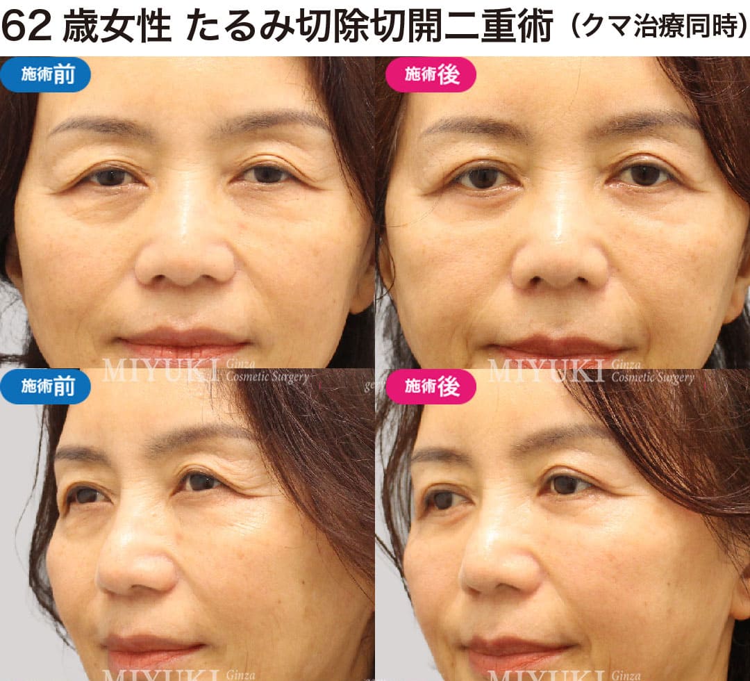 40代から始める大人の二重まぶた治療の症例５