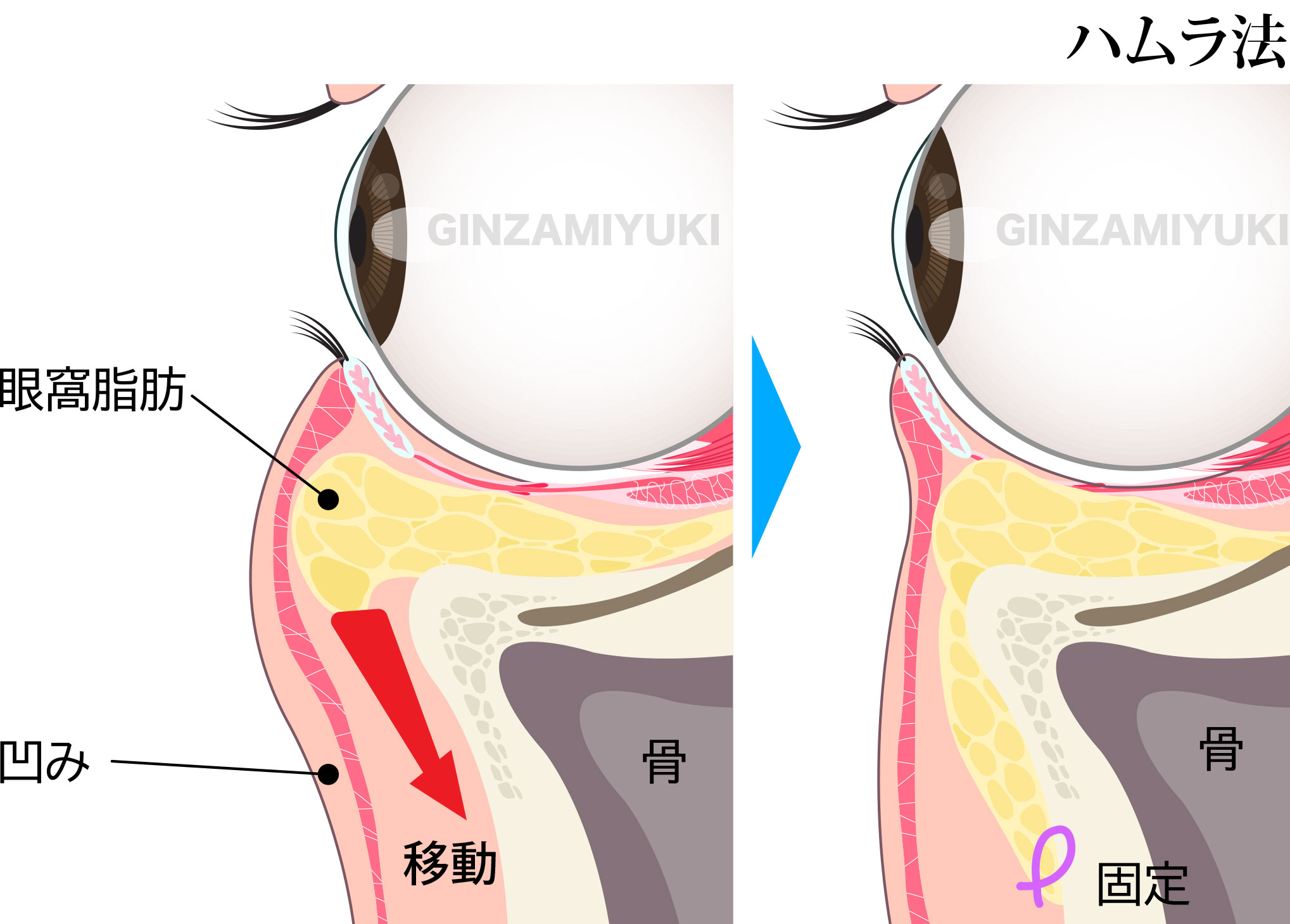 眼窩の構造とハムラ法