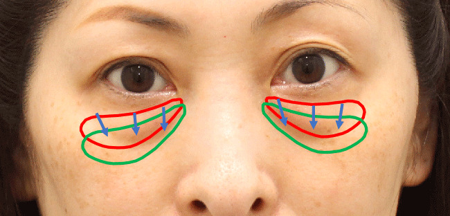 ハムラ法・ティアトラフの凹み範囲