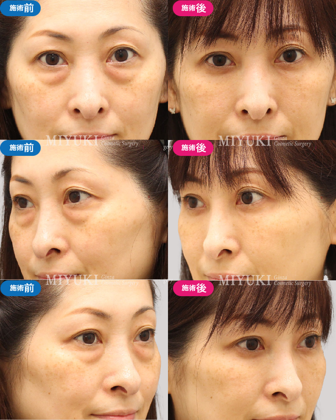 目の下のくま・たるみ改善に有効な「裏ハムラ法」とは