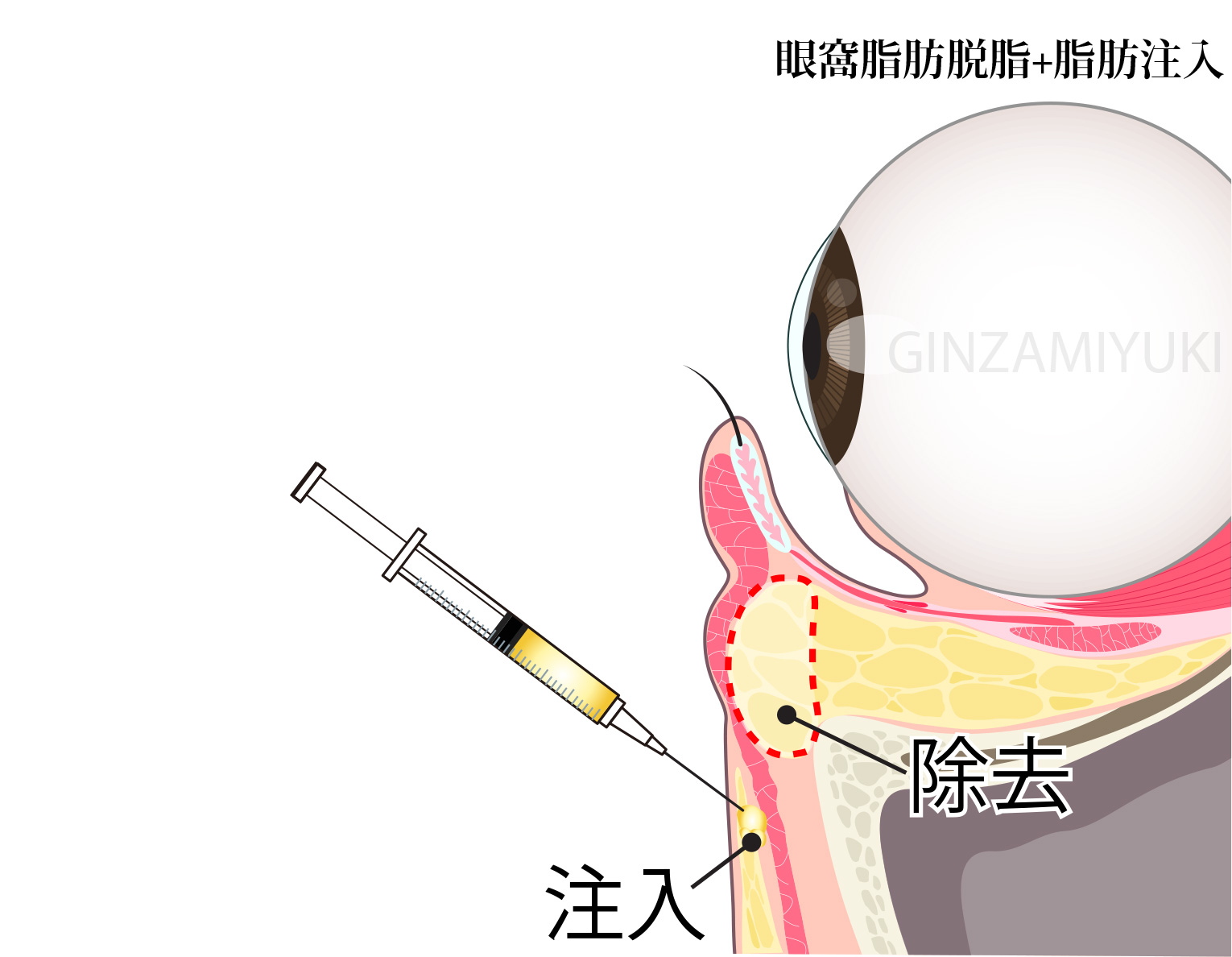 表ハムラ法・脱脂＋脂肪注入との違い「脱脂＋脂肪注入」