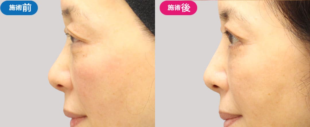 鼻筋プロテーゼで実現する自然な立体感のイメージ