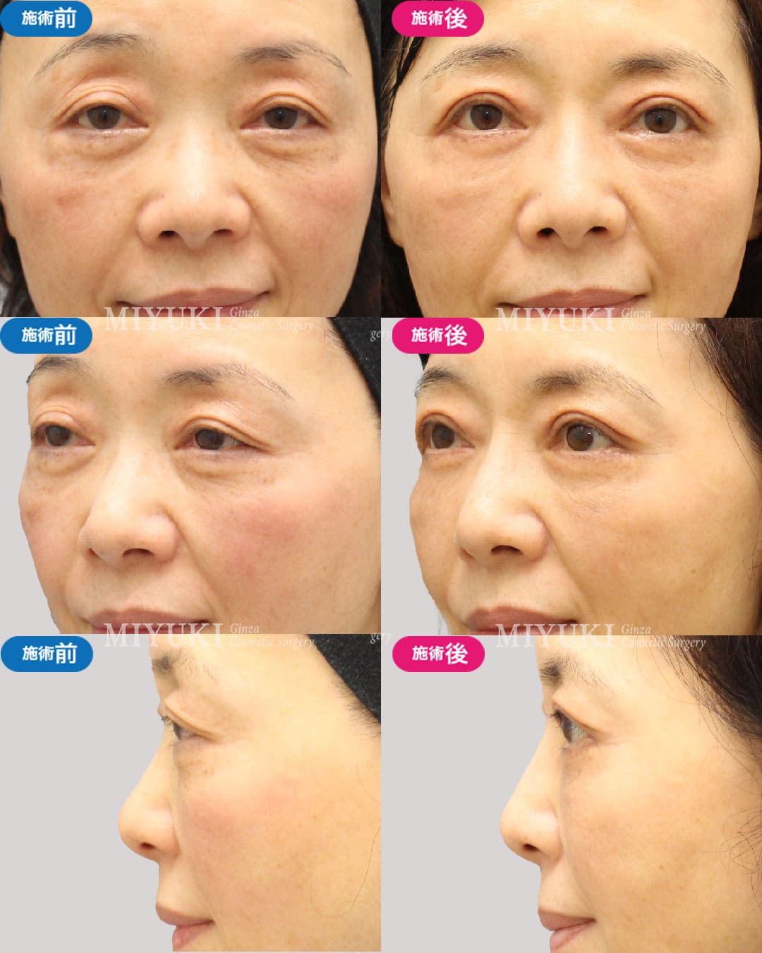 鼻筋プロテーゼの症例１