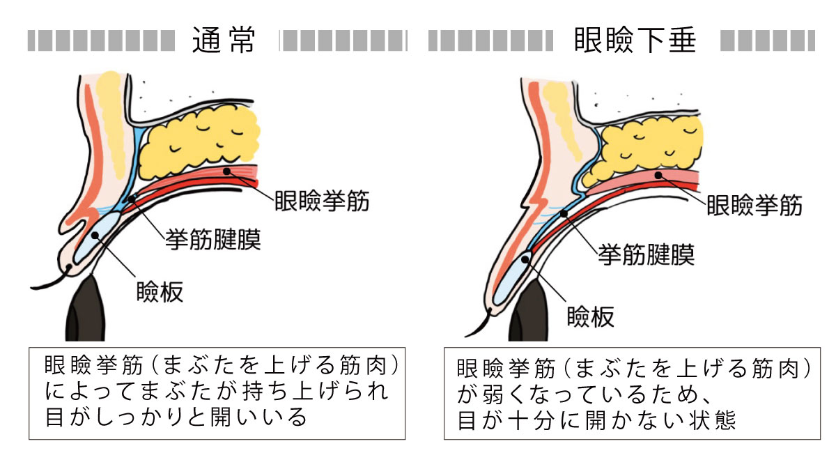 眼瞼下垂イメージ2