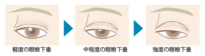眼瞼下垂イメージ