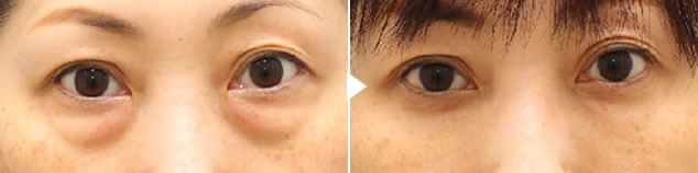 目の下のくま・たるみ治療「裏ハムラ法」の症例